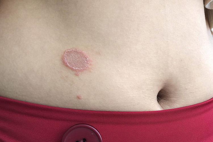 体癣鳞屑性斑图