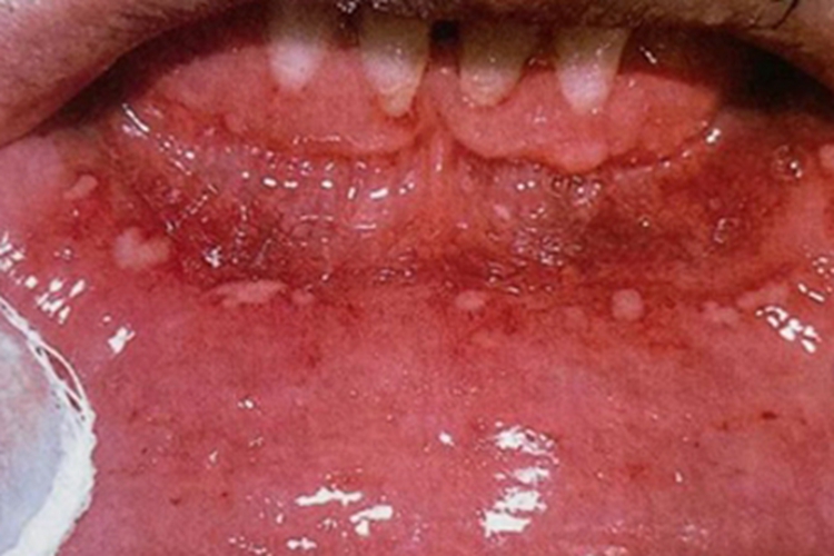疱疹样溃疡唇内侧溃疡图