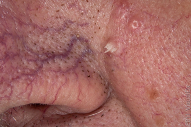 丝状疣面部肉赘图