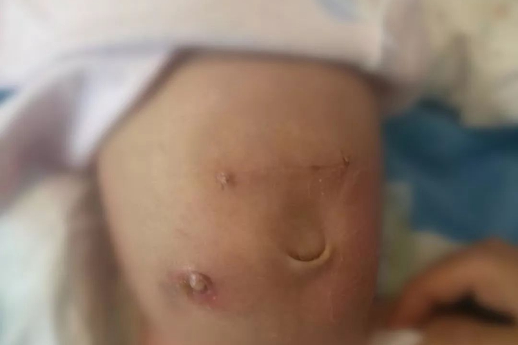 新生儿造瘘好了图 新生儿造瘘好了图