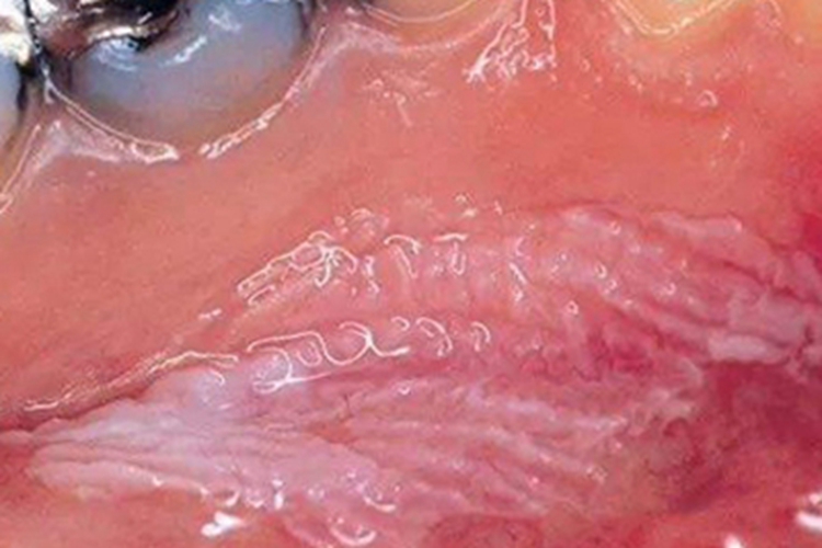 口腔毛状黏膜白斑口腔白斑图