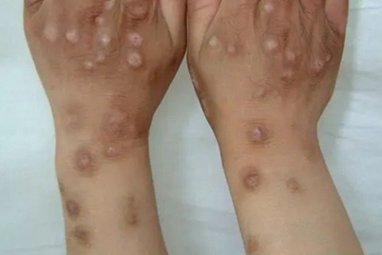 皮肤钙质沉着症手部结节图