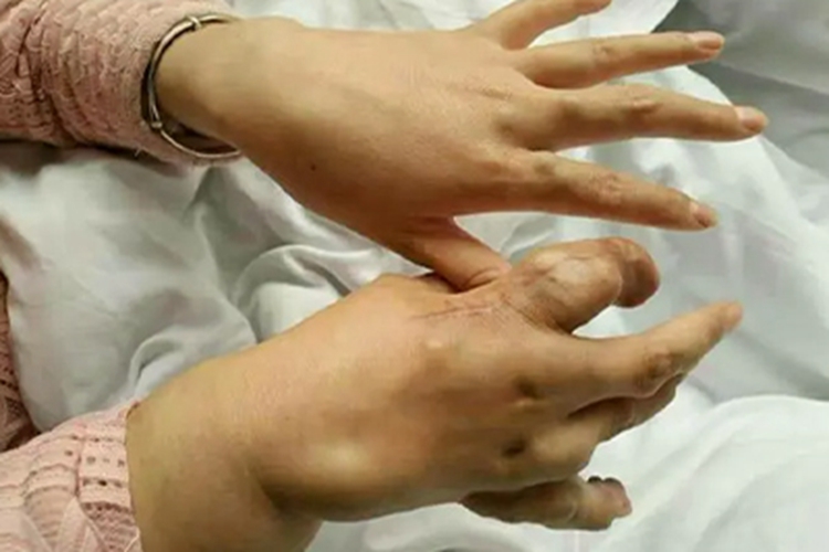 肩手综合征手部畸形图