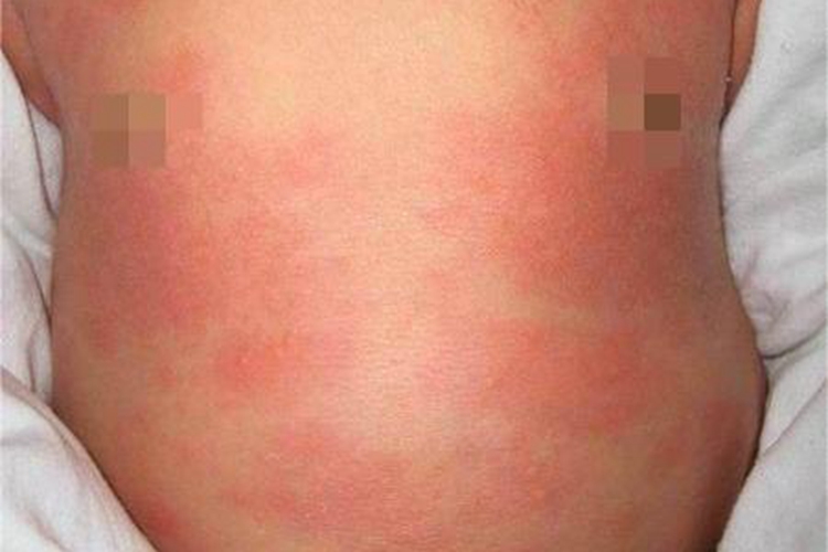 新生儿毒性红斑腹部症状图