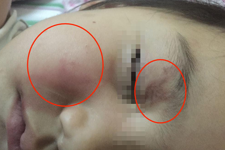 脸部Ⅰ度烧伤图 脸部Ⅰ度烧伤图