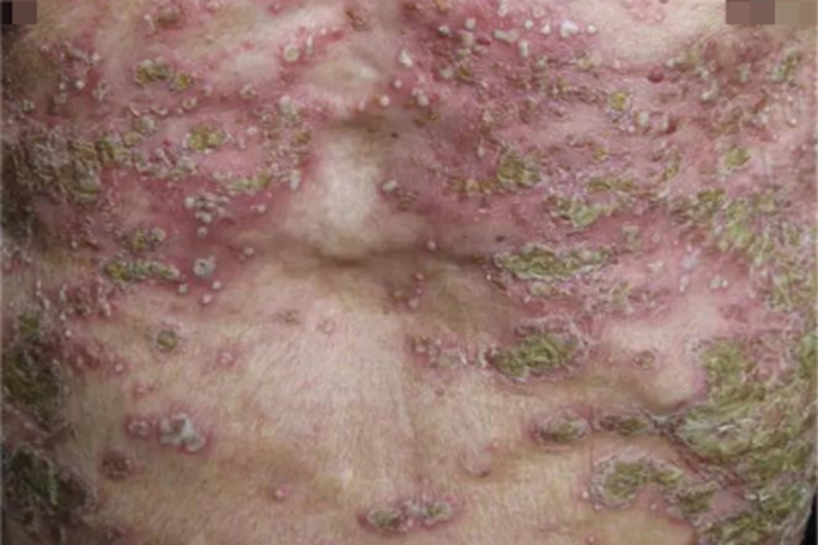 播散性粟粒性皮肤结核胸部症状图