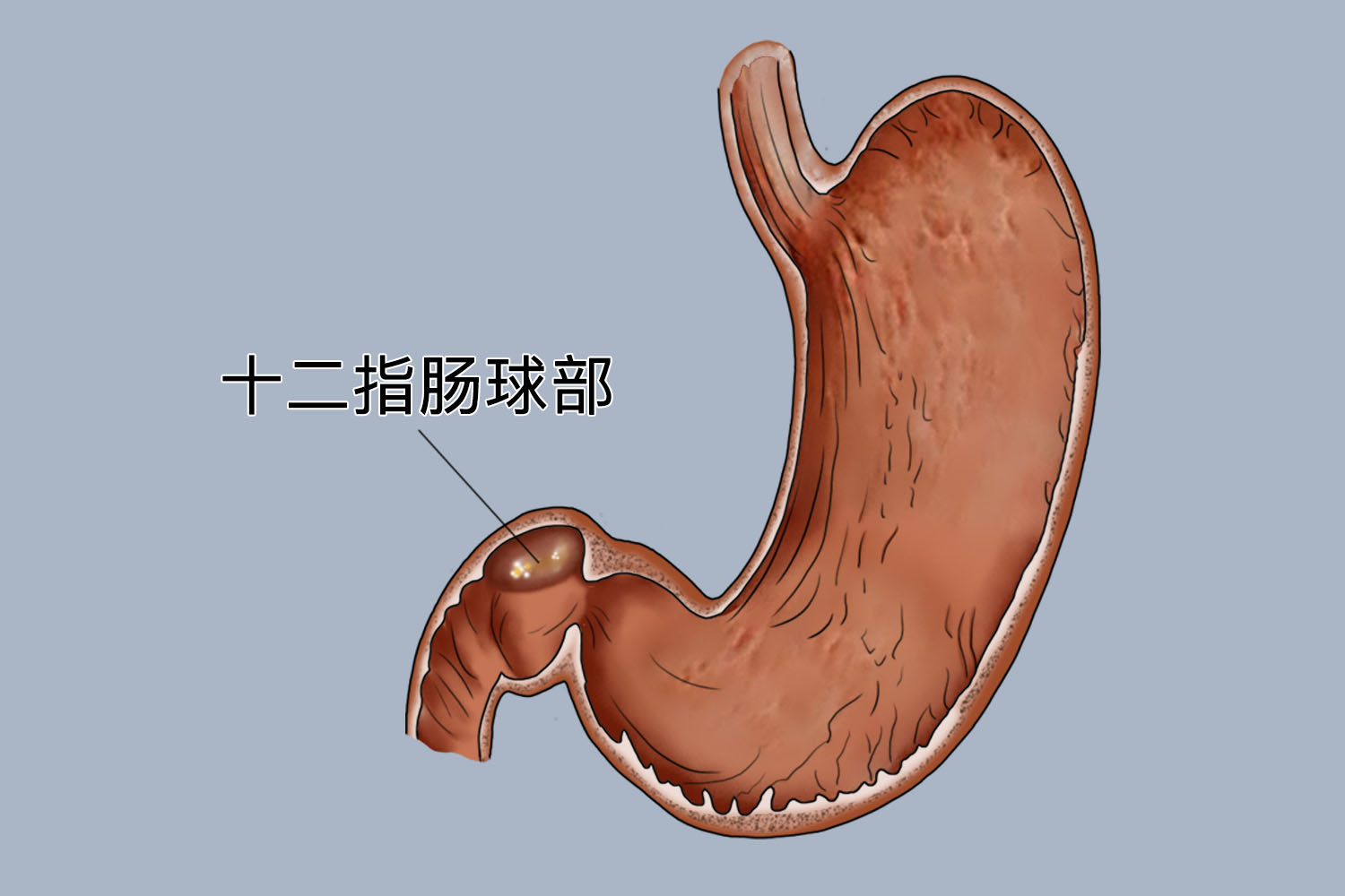 十二指肠球部图