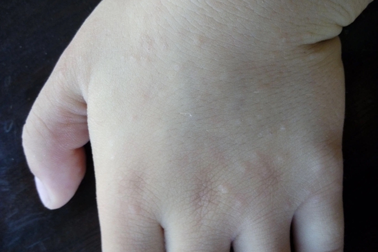 儿童汗疱疹初期图 儿童汗疱疹初期图