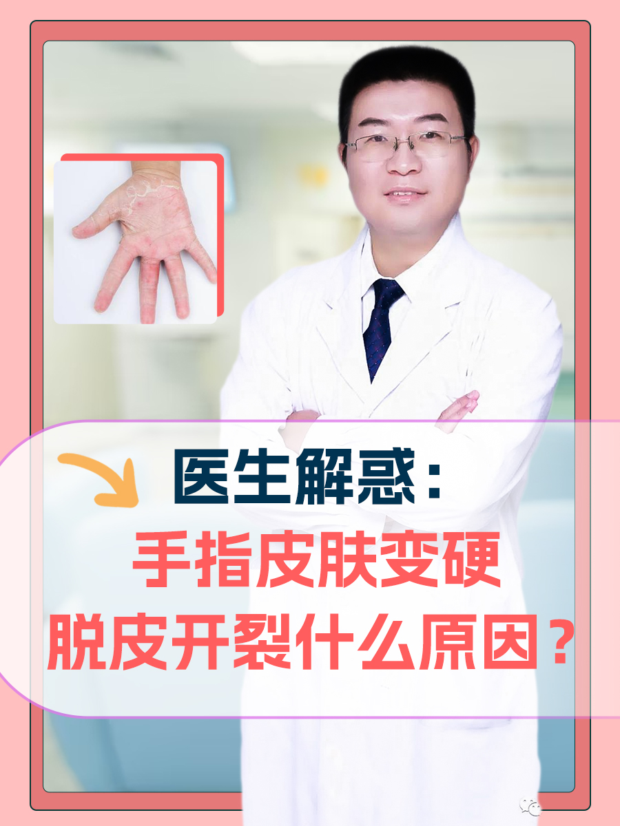 医生解惑：手指皮肤变硬脱皮开裂什么原因？