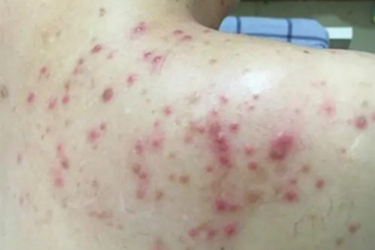 组织胞浆菌病背部疙瘩图