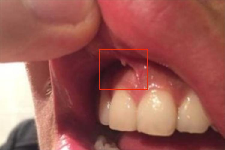 上唇系带断裂自愈图