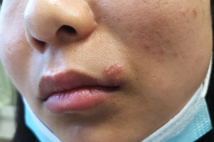 女性面部单纯疱疹图