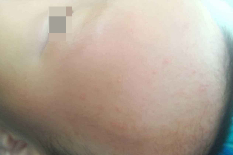 额头外伤局部红肿突出图