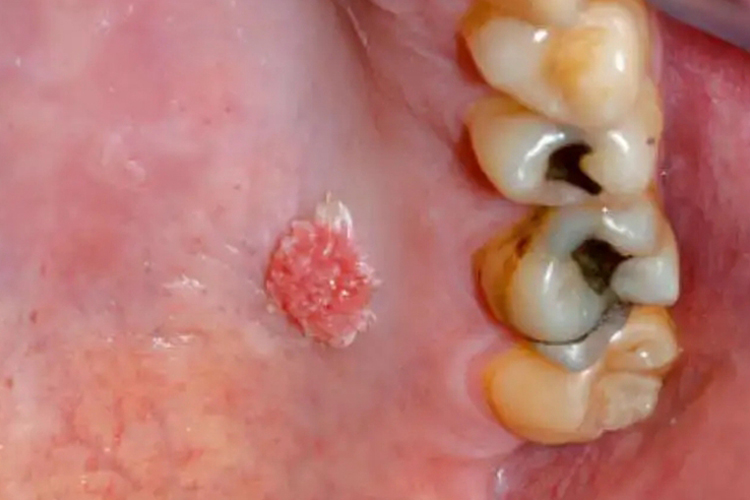 口腔尖锐湿疣赘生物图