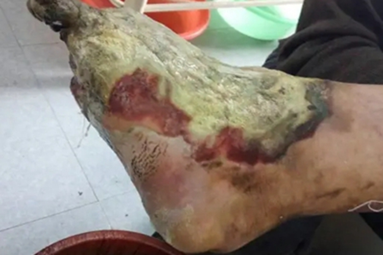 结节性多动脉炎缺损图 结节性多动脉炎缺损图