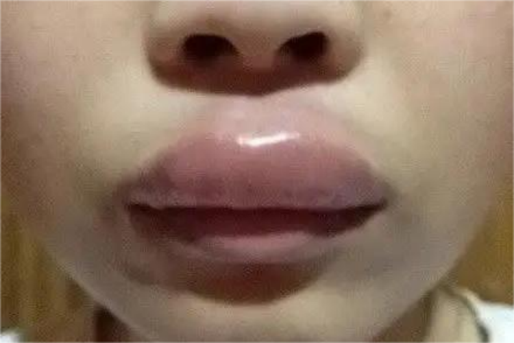 血管性水肿上嘴唇肿图 血管性水肿上嘴唇肿图