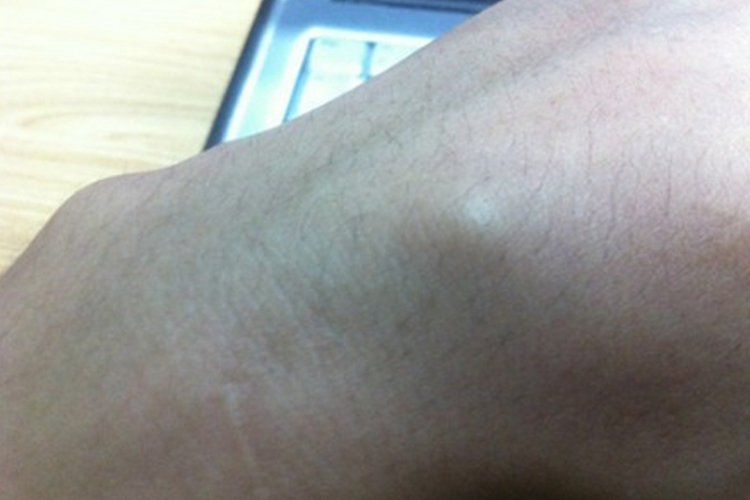 手背脂肪瘤图 手背脂肪瘤图