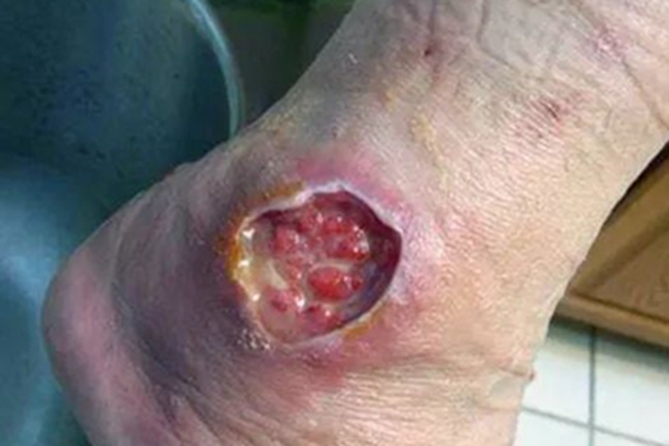 利什曼病脚踝化脓图 利什曼病脚踝化脓图