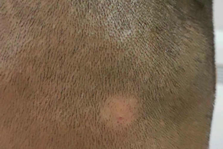 进展期斑秃头皮上有脱发斑图 进展期斑秃头皮上有脱发斑图