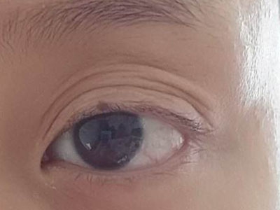 可见患者的左眼上眼皮变薄,弹性减弱,松弛,上眼皮表面的沟纹加深,皱纹