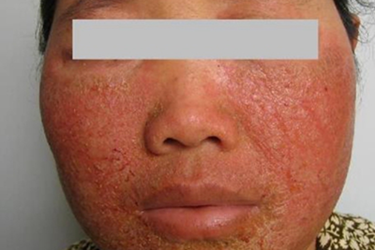 糖皮质激素依赖性皮炎红肿图