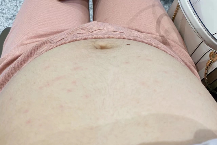 蚊虫叮咬图 蚊虫叮咬图