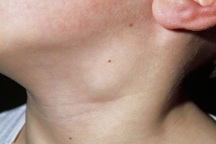 艾滋病中期淋巴结肿大图