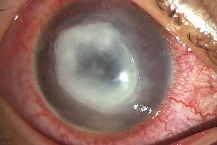 细菌性角膜炎角膜水肿图