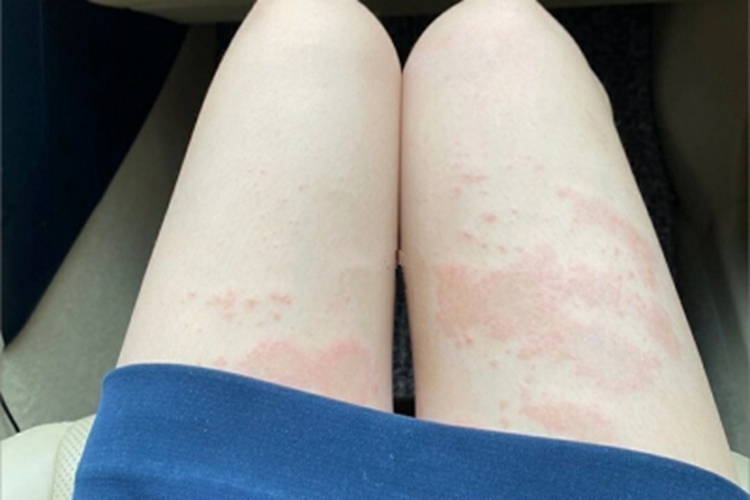 海鲜过敏大腿风团图 海鲜过敏大腿风团图