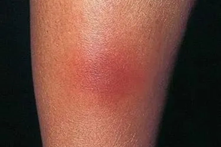 皮下脂质肉芽肿病红肿图