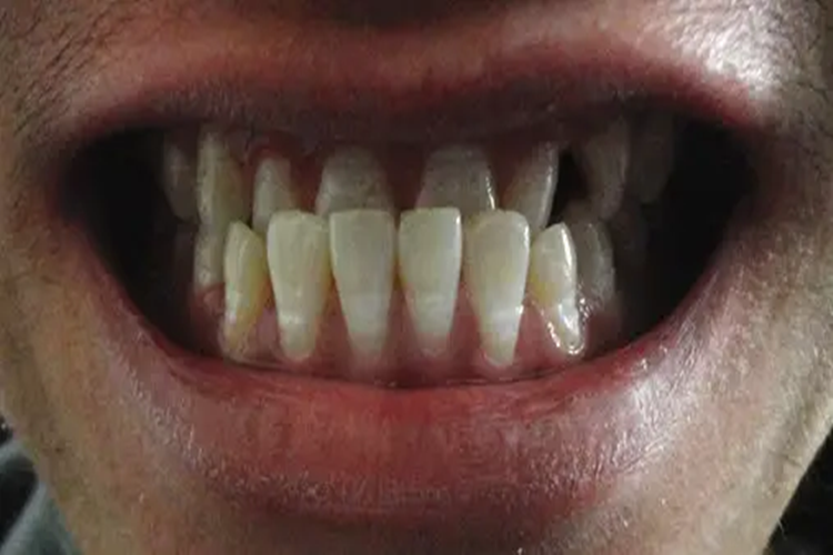 前牙反颌牙齿不平整图