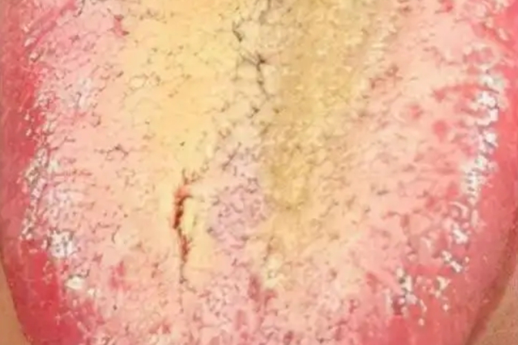 脾胃湿热型慢性胃炎舌苔图 脾胃湿热型慢性胃炎舌苔图