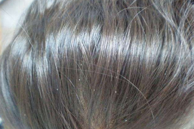 小孩头发上有头虱图 小孩头发上有头虱图