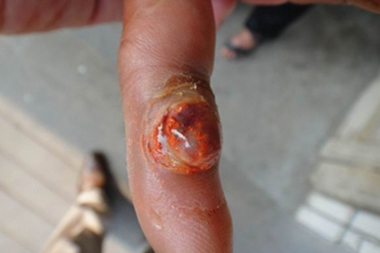 化脓性肉芽肿手指溃疡图