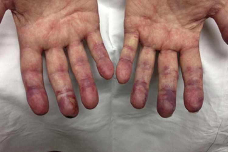 冷凝集素综合征青紫图 冷凝集素综合征青紫图