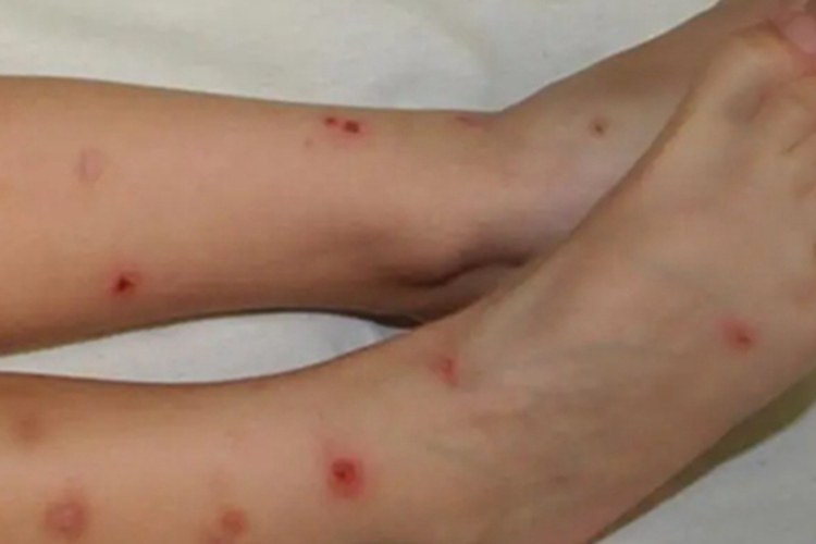 蠓虫叮咬脚上水疱破了图