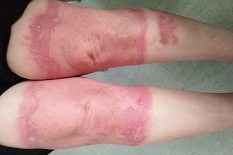 亚急性接触性皮炎膝盖红斑图