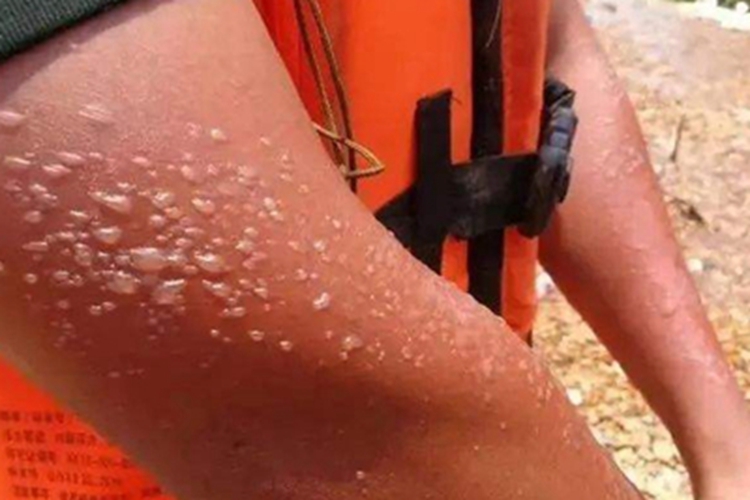 日光性皮炎胳膊上水疱图