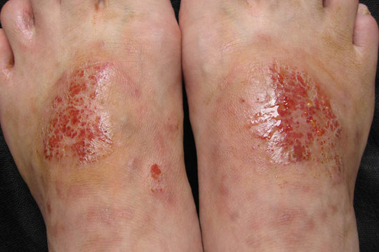 脚部急性湿疹图