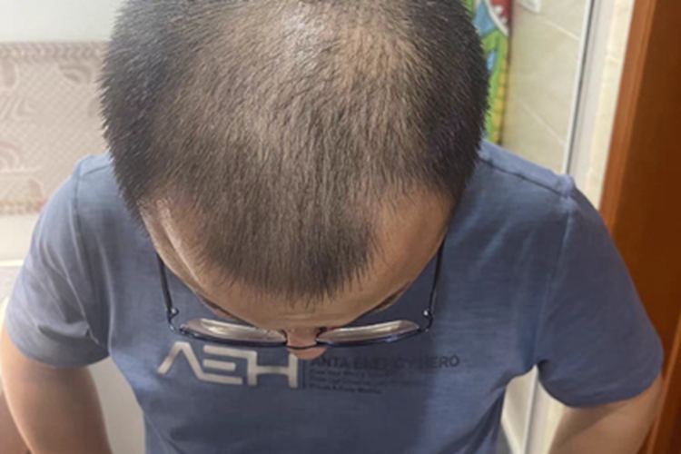 雄激素性脱发头发脱落稀少图