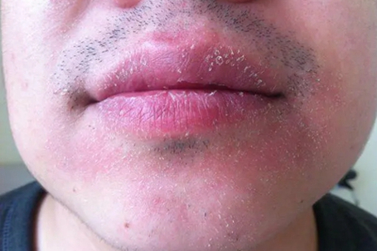 锌缺乏症红斑图 锌缺乏症红斑图