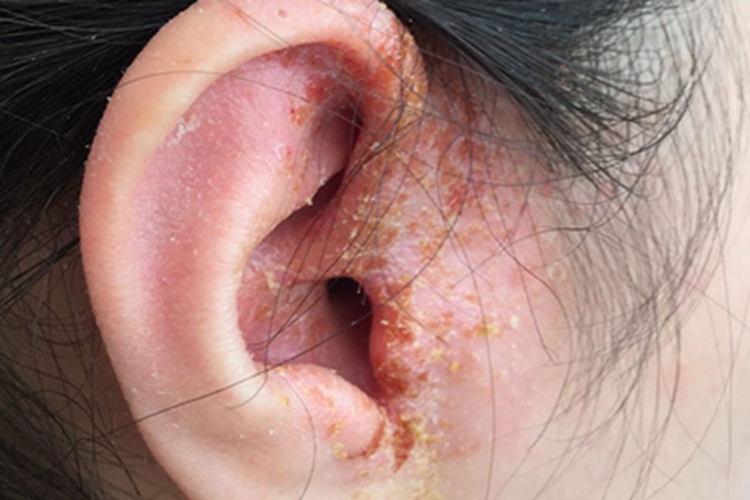 亚急性湿疹耳周结痂图