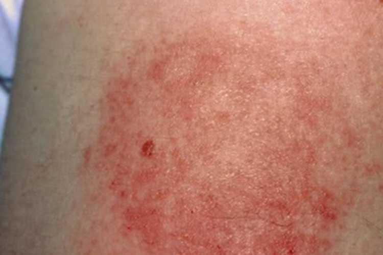 急性湿疹大腿红色丘疹图