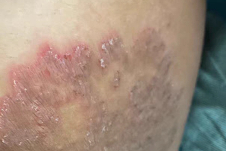 股癣大腿根有发红脱皮图