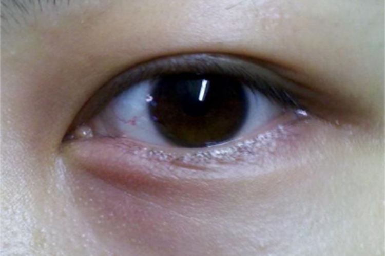 眦角性睑缘炎眼角红肿图 眦角性睑缘炎眼角红肿图