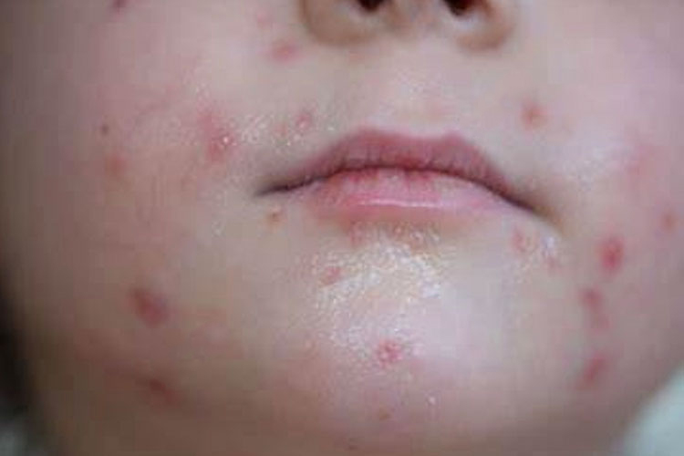 面部水痘图