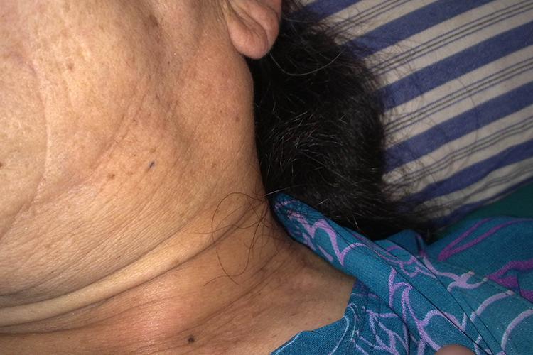 颈部淋巴结肿瘤图