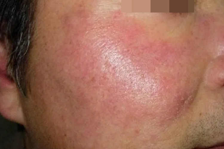 脸部日光性皮炎图 脸部日光性皮炎图