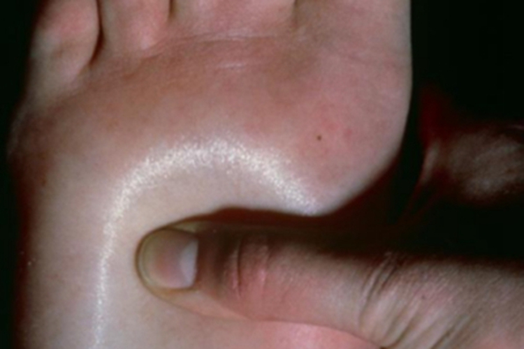 全身性黏液性水肿脚部水肿图