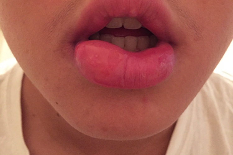 海绵状淋巴管瘤变形图